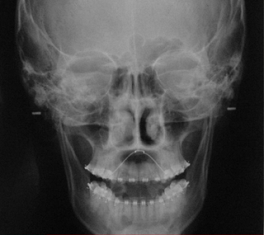 Rayos x o radiografia de senos paranasales